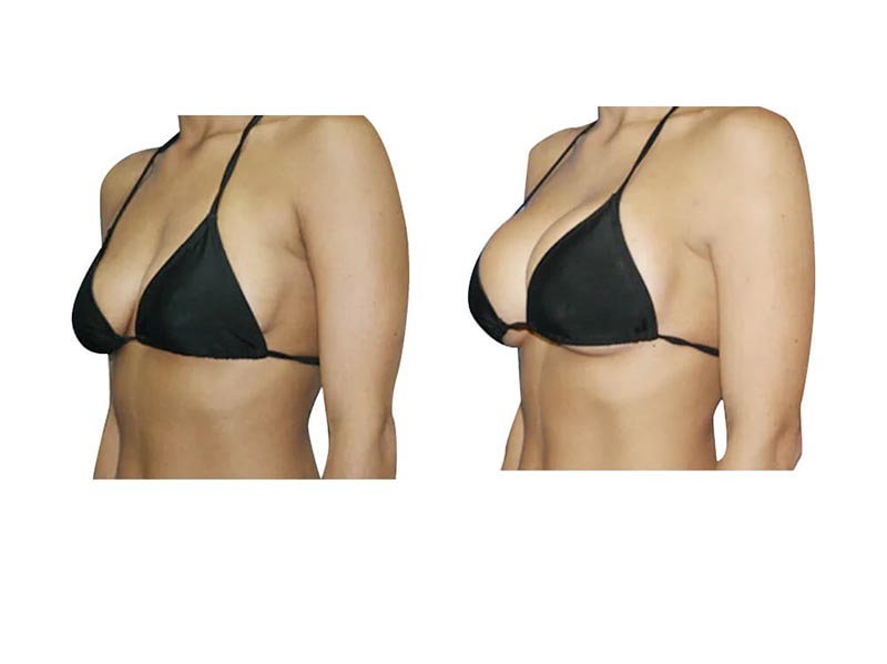 Vakumla Meme Büyütme